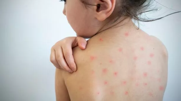 Unveiling the 15 Secrets How Varicella Zoster Virus Hijacks Your Body's Defenses