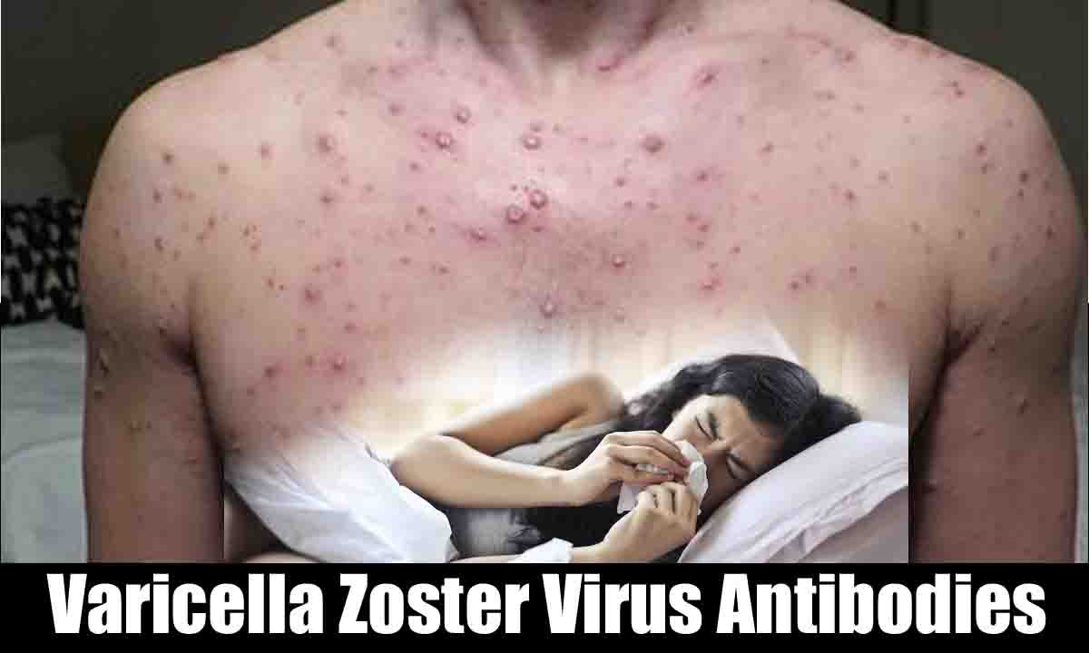 10 Ways to Unleash the Mighty Varicella Zoster Virus Antibodies: Your Body's Ultimate Defense Against Chickenpox and Shingles