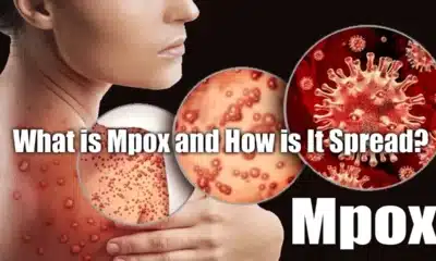 What is Mpox and How is It Spread A Comprehensive Guide