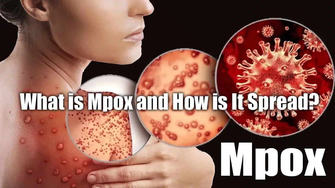 What is Mpox and How is It Spread A Comprehensive Guide